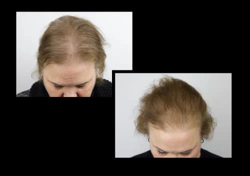 AnteAGE exosome therapy with SkinPen microneedling — before and after hair restoration results