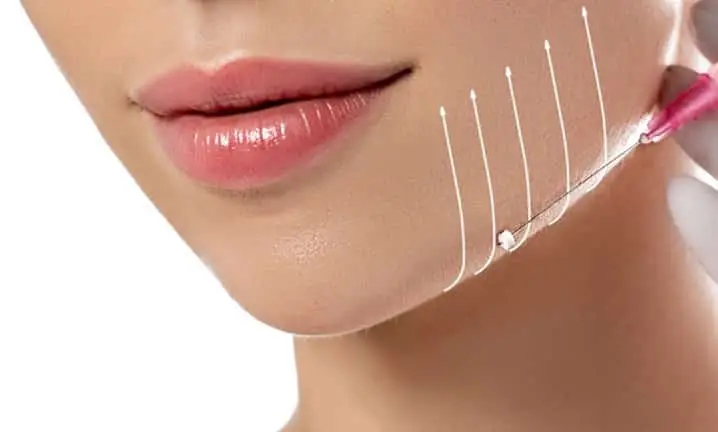 PDO thread lift treatment at Berkshire Aesthetics