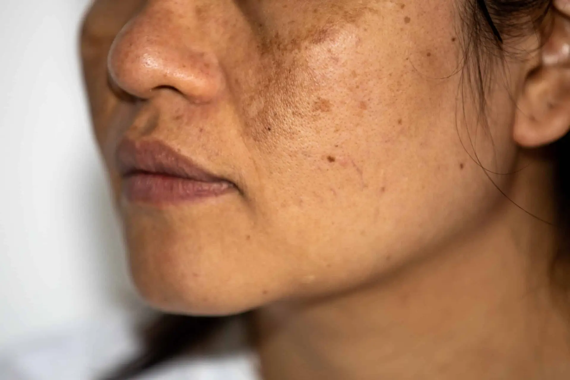 Close-up of facial hyperpigmentation and melasma on the cheek