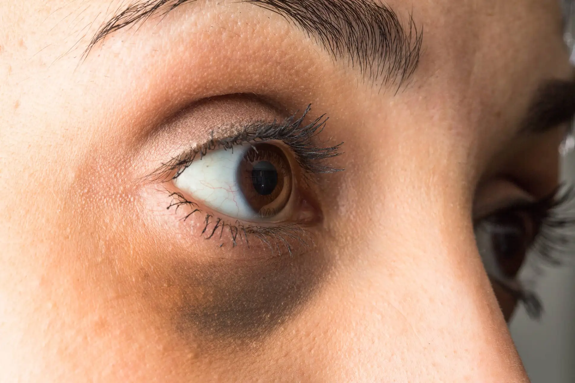 Under-eye dark circles treated with polynucleotide injections at Berkshire Aesthetics