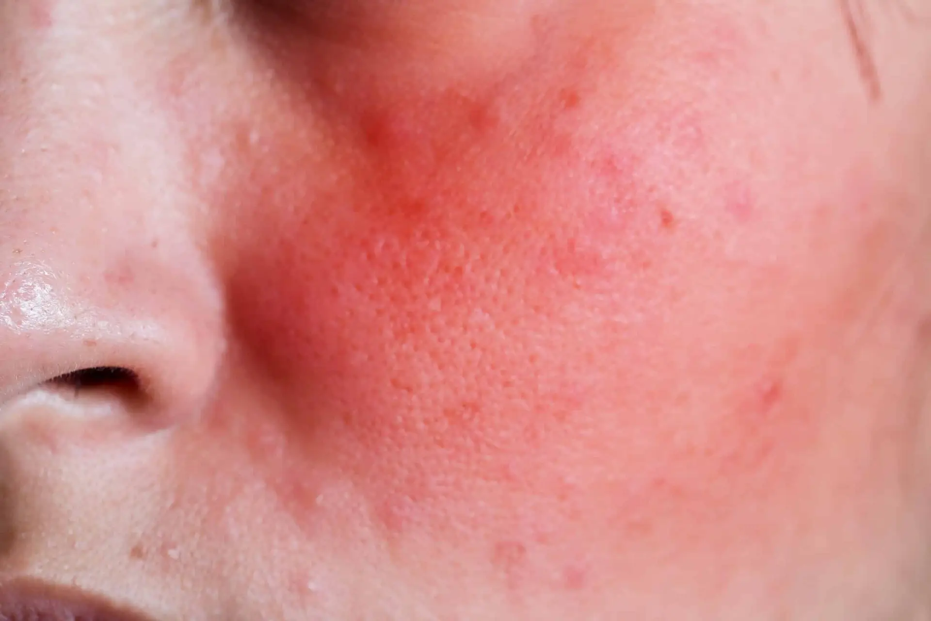 Close-up of facial redness and flushing associated with rosacea