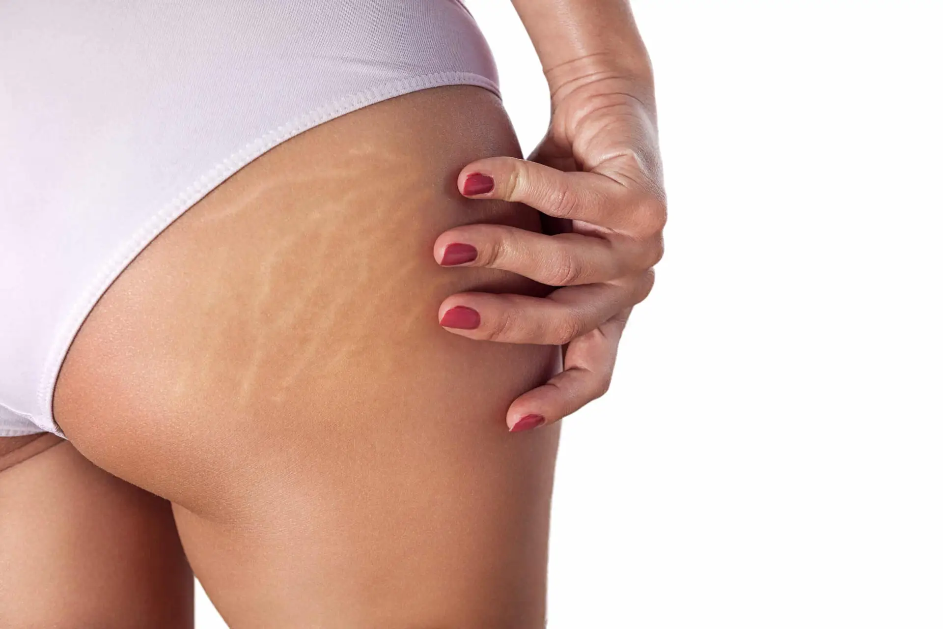 Close-up of stretch marks on the thigh area