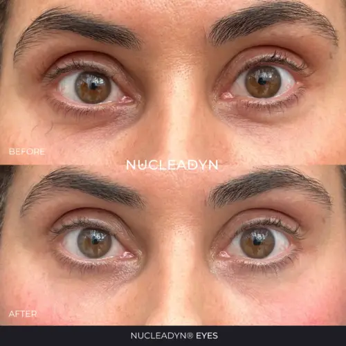 Nucleadyn-Eyes-Before-After-Results-05
