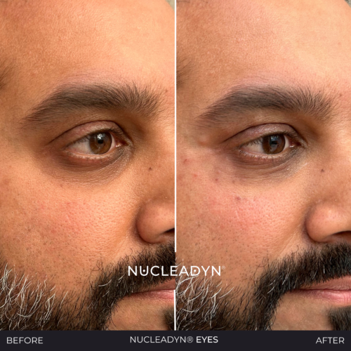 Nucleadyn-Eyes-Before-After-Results-10