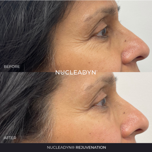 Nucleadyn-Rejuvenation-Before-After-Results-02