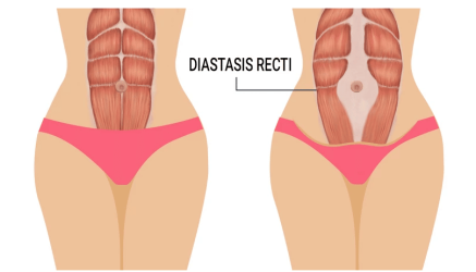 Diastasis recti